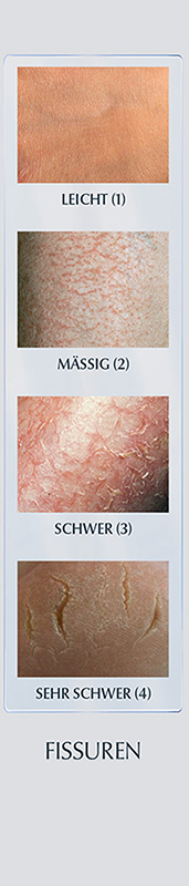 xerosimeter 4
